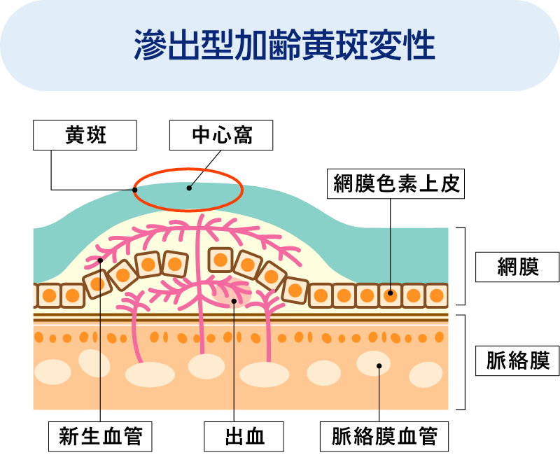 滲出型加齢黄斑変性