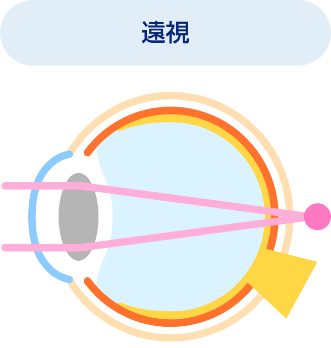 遠視
