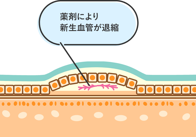 滲出型加齢黄斑変性