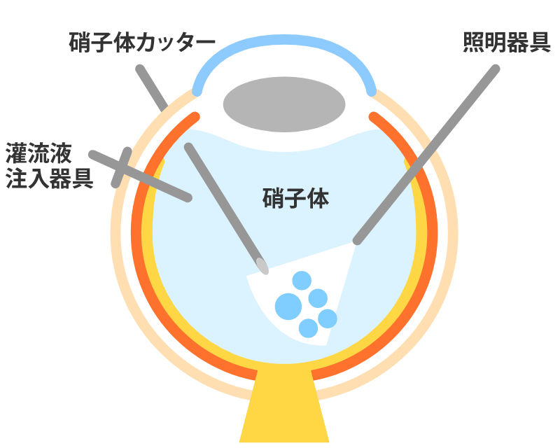 硝子体手術
